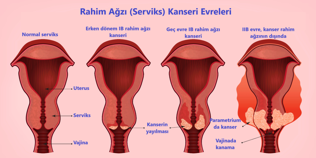 rahim agzi kanseri belirtileri nelerdir prof dr korhan kahraman